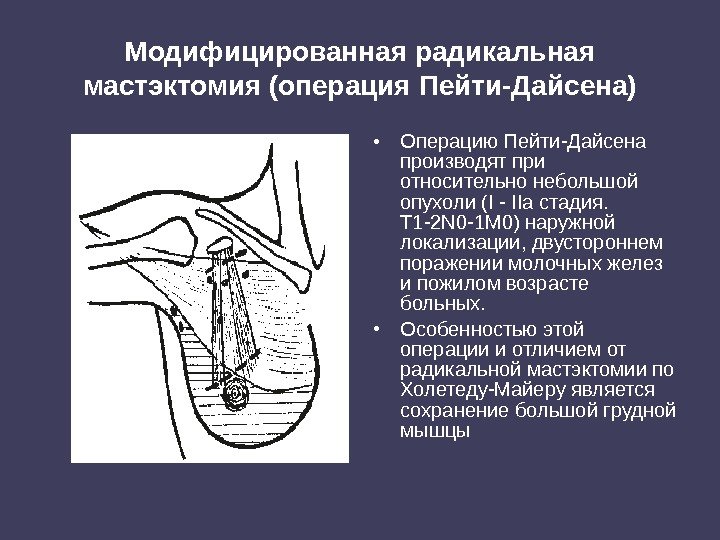 Модифицированная радикальная мастэктомия (операция Пейти-Дайсена) • Операцию Пейти-Дайсена производят при относительно небольшой опухоли (I