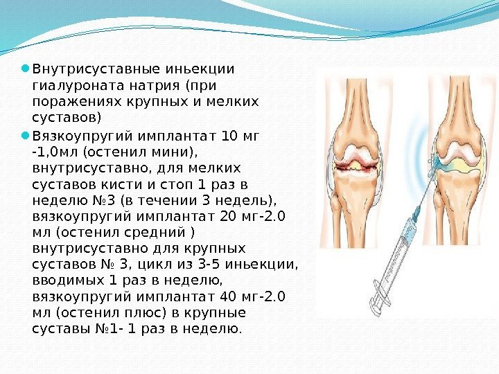  Внутрисуставные иньекции гиалуроната натрия (при поражениях крупных и мелких суставов)  Вязкоупругий имплантат