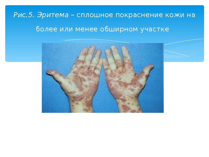 Рис. 5. Эритема – сплошное покраснение кожи на более или менее обширном участке 