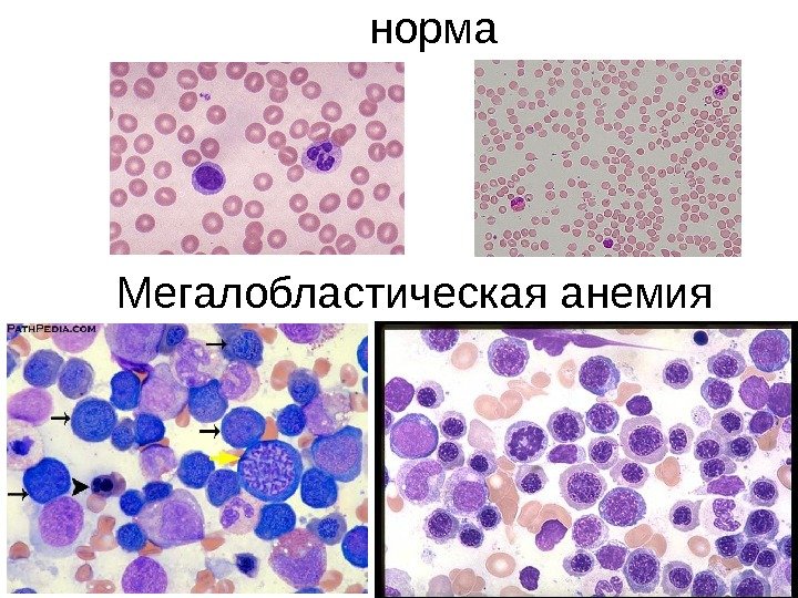   Мегалобластическая анемия норма 