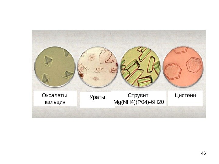 46 Оксалаты кальция Ураты Цистеин Струвит Mg(NH 4)(P 04)-6 H 20 