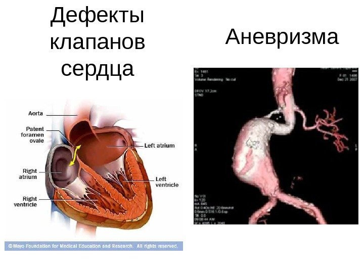 Аневризма. Дефекты клапанов сердца 