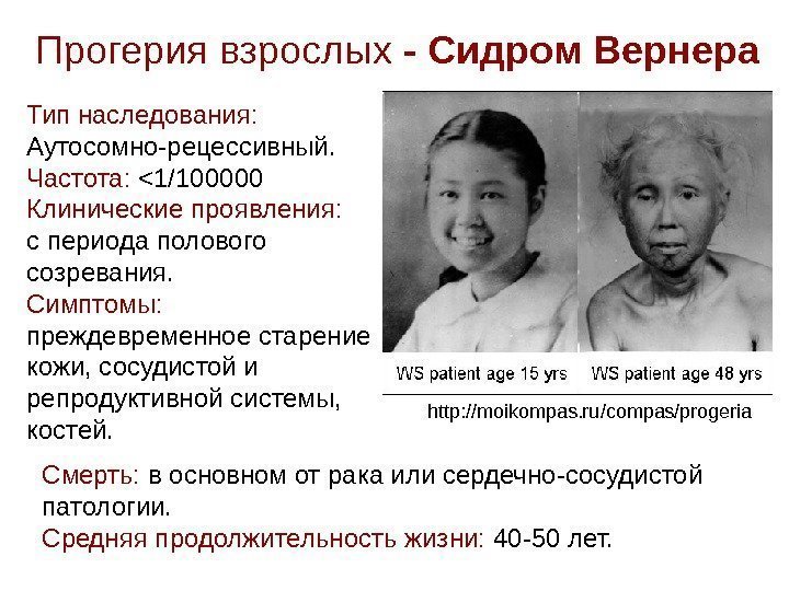   Прогерия взрослых - Сидром Вернера Тип наследования:  Аутосомно-рецессивный. Частота:  1/100000