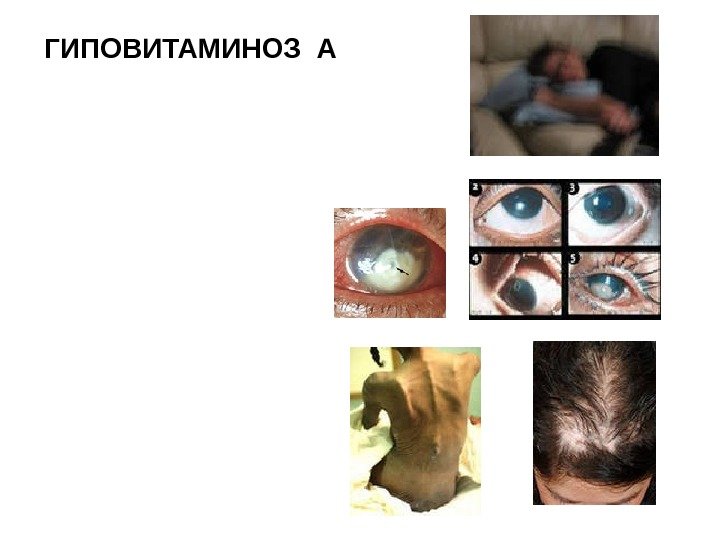 ГИПОВИТАМИНОЗ А -куриная слепота у взрослых ; - ксерофтальмия (сухость оболочек глаза);  