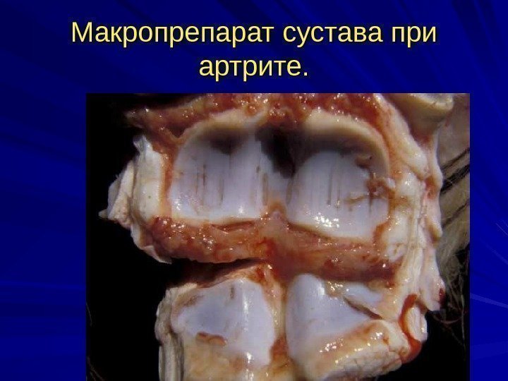 Макропрепарат сустава при артрите. 