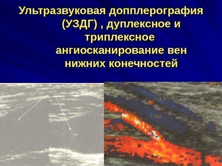 Ультразвуковая допплерография (УЗДГ) , дуплексное и триплексное  ангиосканирование вен нижних конечностей 