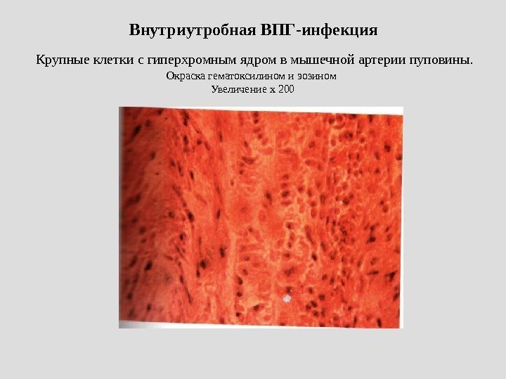  Внутриутробная ВПГ-инфекция  Крупные клетки с гиперхромным ядром в мышечной артерии пуповины. 