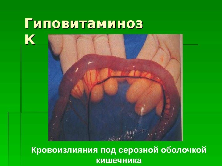   Гиповитаминоз КК Кровоизлияния под серозной оболочкой кишечника  