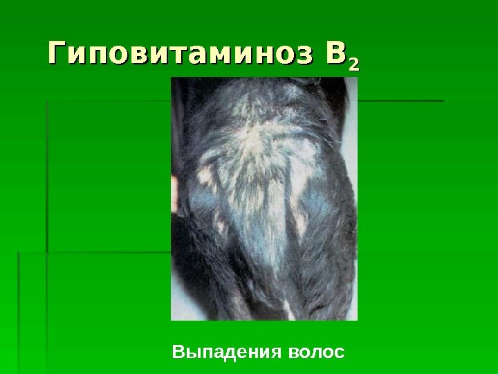   Гиповитаминоз В 22 Выпадения волос  