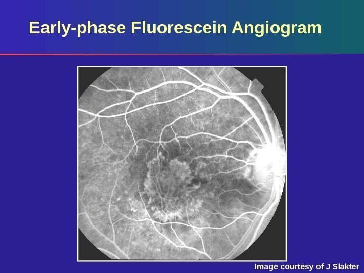 Early-phase Fluorescein Angiogram Image courtesy of J Slakter 