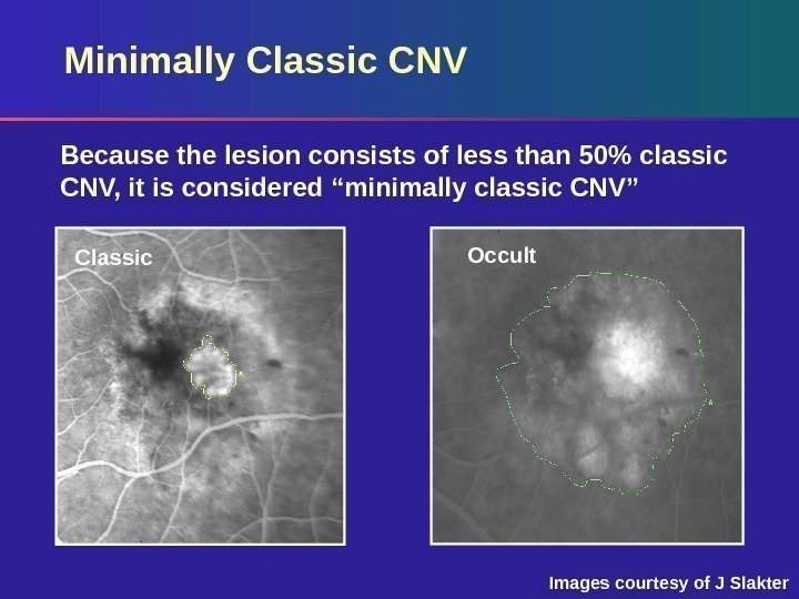 Minimally Classic CNV Classic Occult. Because the lesion consists of less than 50 classic