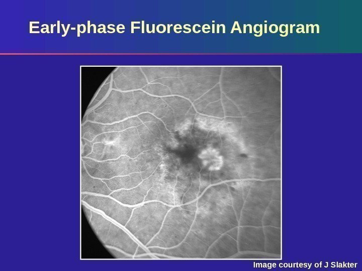 Early-phase Fluorescein Angiogram Image courtesy of J Slakter 