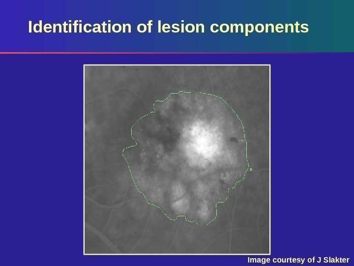 Image courtesy of J Slakter. Identification of lesion components 
