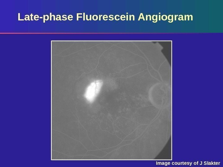 Late-phase Fluorescein Angiogram Image courtesy of J Slakter 