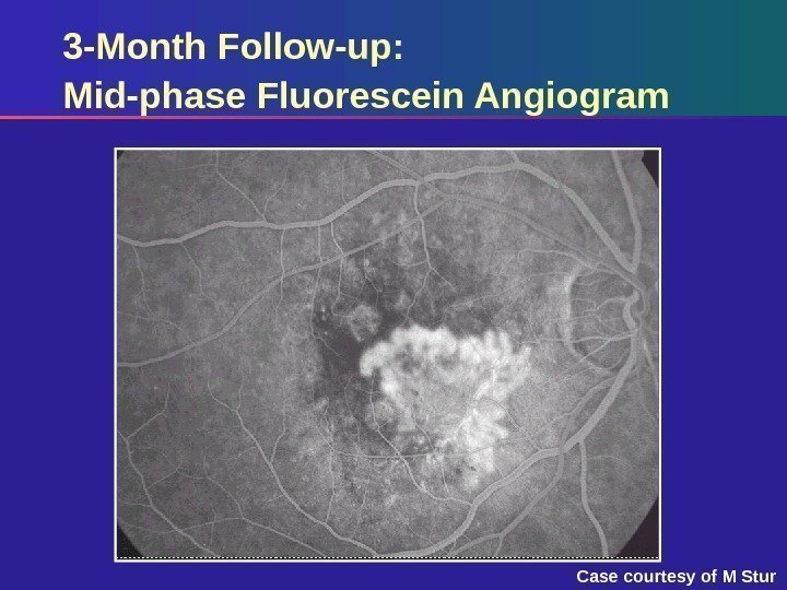 3 -Month Follow-up:  Mid-phase Fluorescein Angiogram Case courtesy of M Stur 