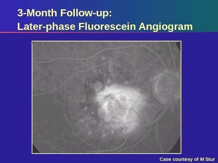 3 -Month Follow-up:  Later-phase Fluorescein Angiogram Case courtesy of M Stur 