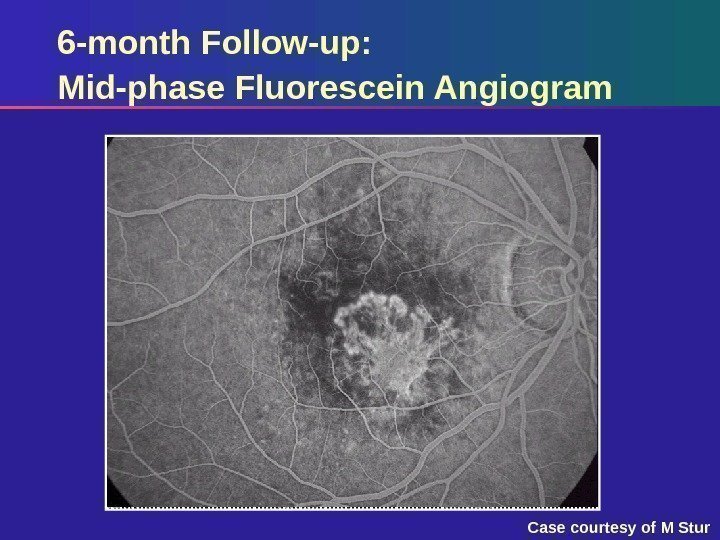 6 -month Follow-up: Mid-phase Fluorescein Angiogram Case courtesy of M Stur 