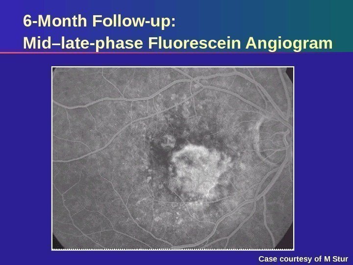6 -Month Follow-up: Mid–late-phase Fluorescein Angiogram Case courtesy of M Stur 