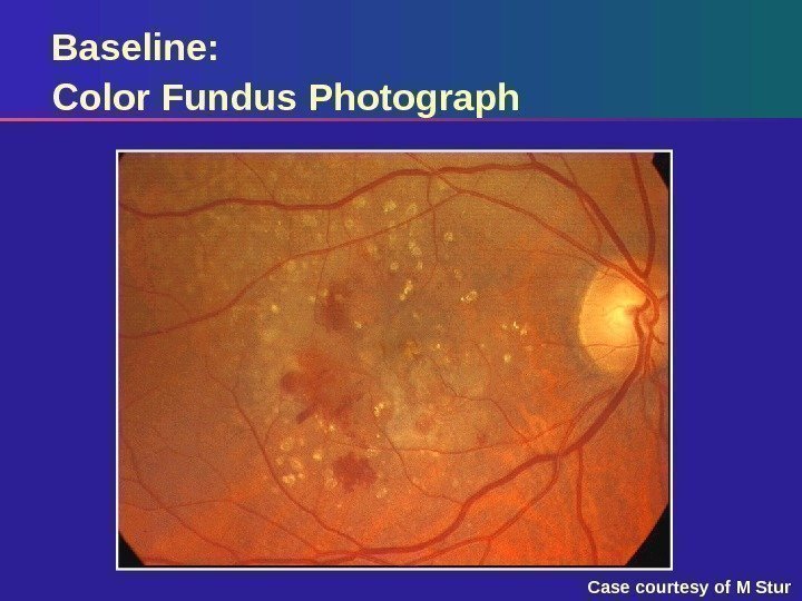 Baseline:  Color Fundus Photograph Case courtesy of M Stur 