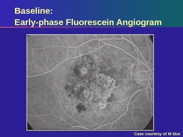 Baseline: Early-phase Fluorescein Angiogram Case courtesy of M Stur 