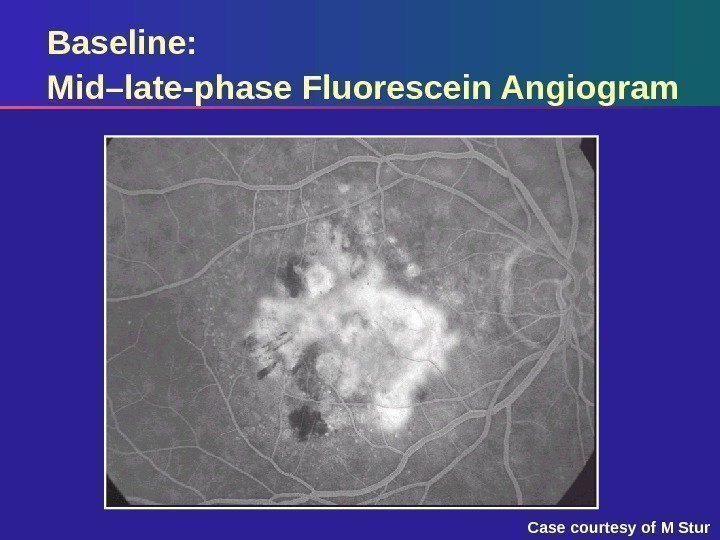 Baseline:  Mid–late-phase Fluorescein Angiogram Case courtesy of M Stur 
