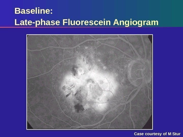 Baseline: Late-phase Fluorescein Angiogram Case courtesy of M Stur 