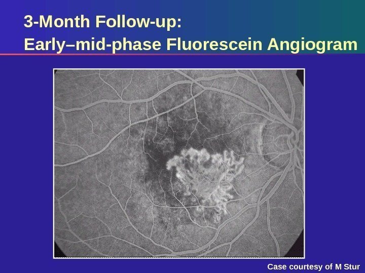 3 -Month Follow-up:  Early–mid-phase Fluorescein Angiogram Case courtesy of M Stur 