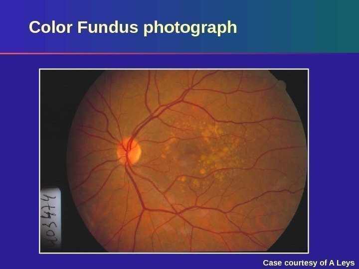 Color Fundus photograph Case courtesy of A Leys 