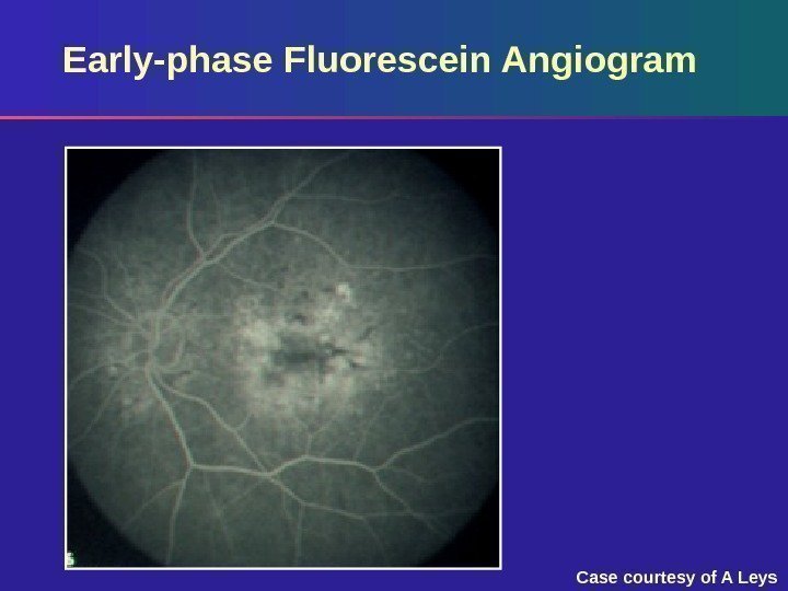 Early-phase Fluorescein Angiogram Case courtesy of A Leys 