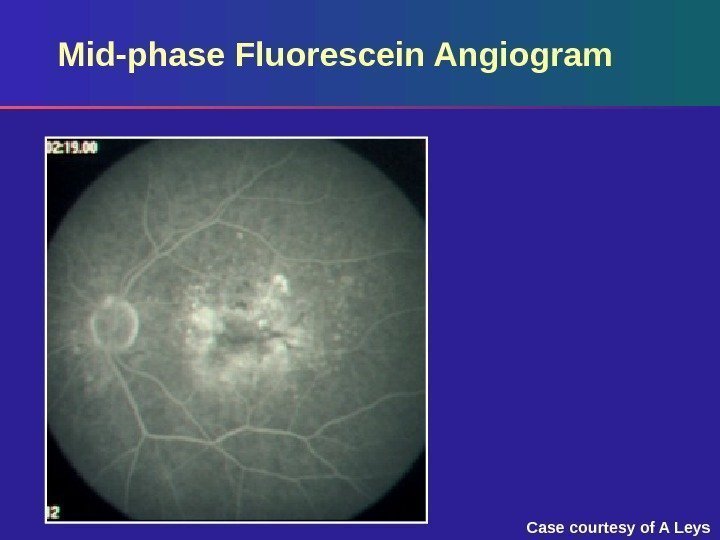 Mid-phase Fluorescein Angiogram Case courtesy of A Leys 