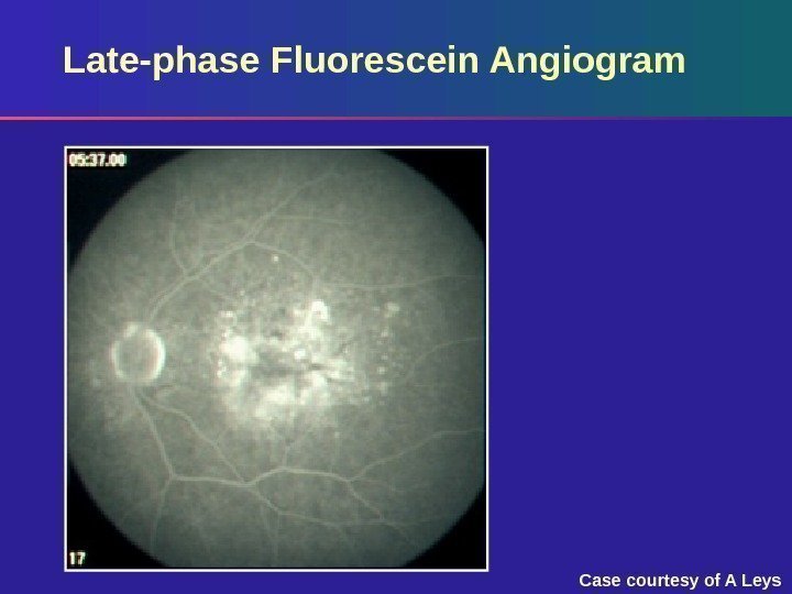 Late-phase Fluorescein Angiogram Case courtesy of A Leys 