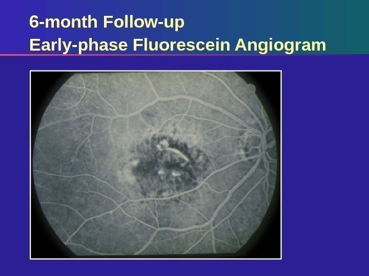 6 -month Follow-up Early-phase Fluorescein Angiogram 
