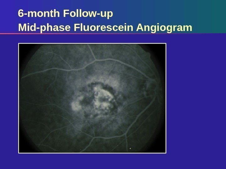 6 -month Follow-up Mid-phase Fluorescein Angiogram 