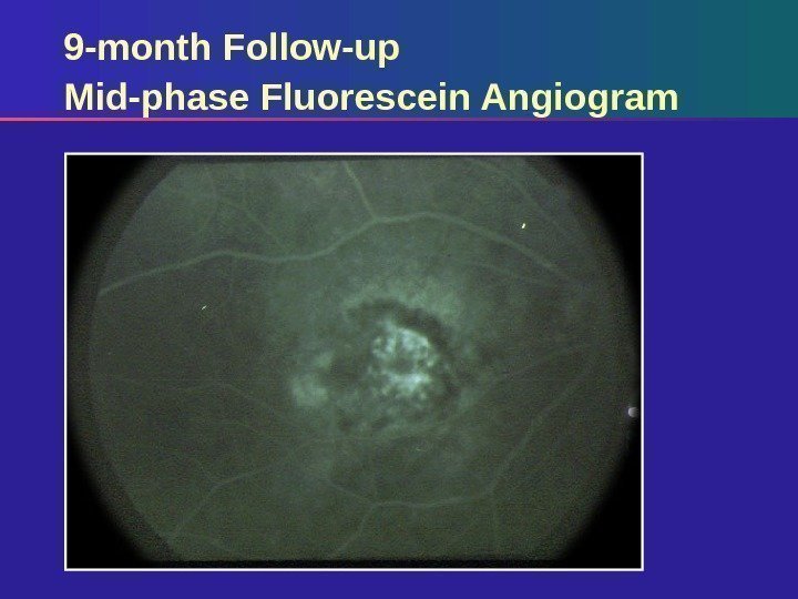 9 -month Follow-up Mid-phase Fluorescein Angiogram 