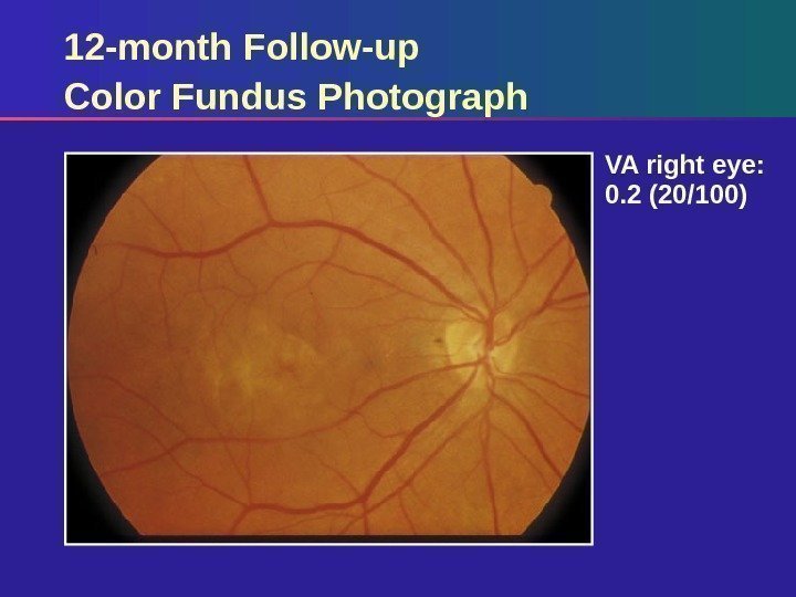 12 -month Follow-up Color Fundus Photograph VA right eye:  0. 2 (20/100) 