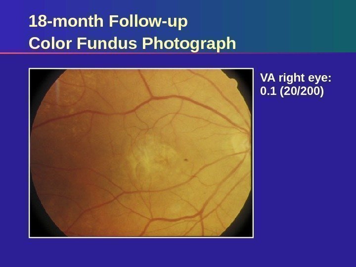 18 -month Follow-up Color Fundus Photograph VA right eye:  0. 1 (20/200) 