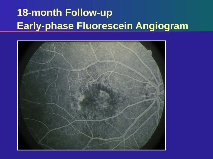 18 -month Follow-up Early-phase Fluorescein Angiogram 