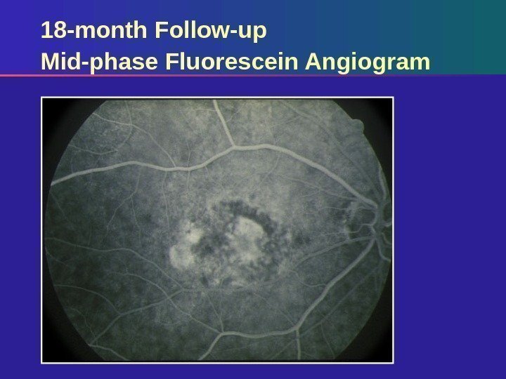 18 -month Follow-up Mid-phase Fluorescein Angiogram 