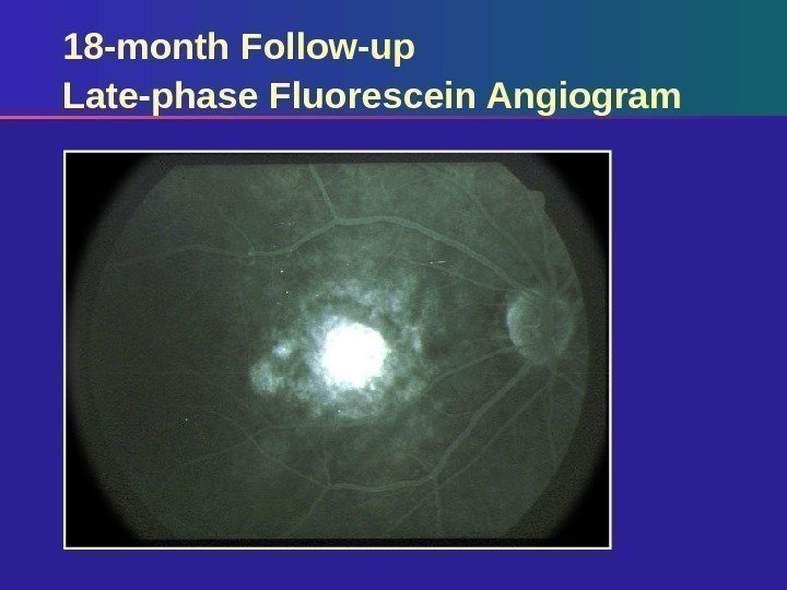 18 -month Follow-up Late-phase Fluorescein Angiogram 