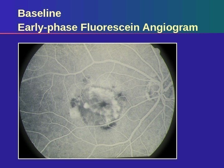 Baseline Early-phase Fluorescein Angiogram 