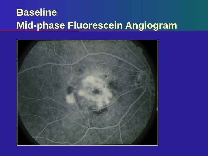 Baseline Mid-phase Fluorescein Angiogram 