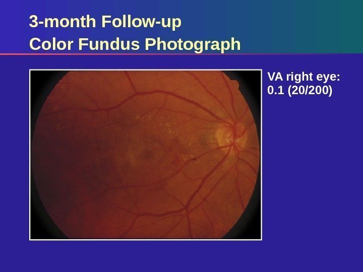 3 -month Follow-up Color Fundus Photograph VA right eye:  0. 1 (20/200) 