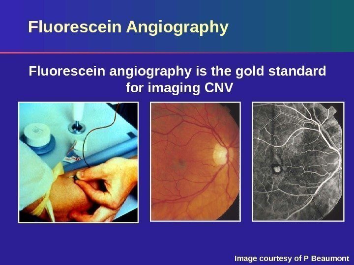 Fluorescein Angiography Fluorescein angiography is the gold standard for imaging CNV Image courtesy of