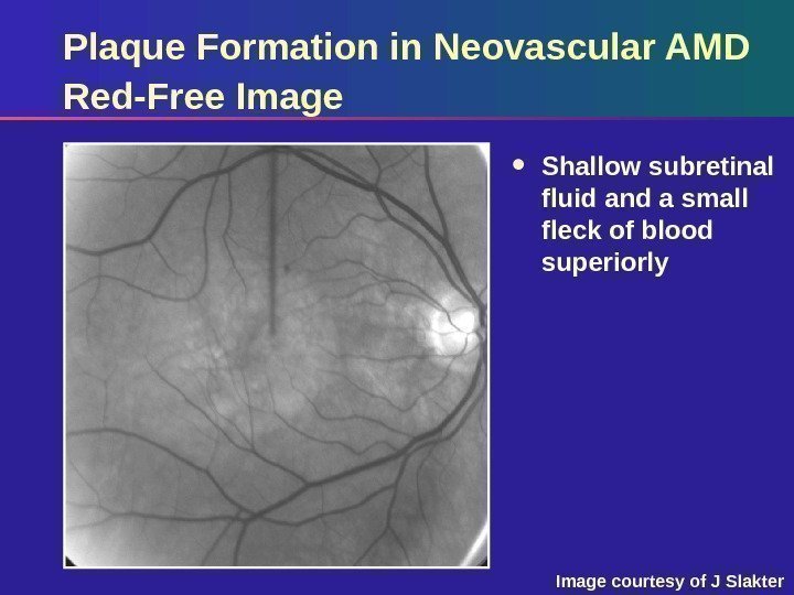 Plaque Formation in Neovascular AMD Red-Free Image Shallow subretinal fluid and a small fleck