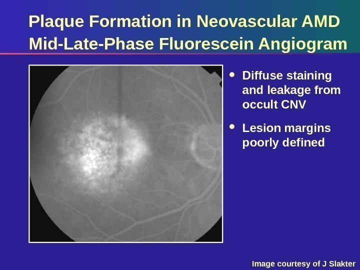 Plaque Formation in Neovascular AMD Mid-Late-Phase Fluorescein Angiogram Diffuse staining and leakage from occult