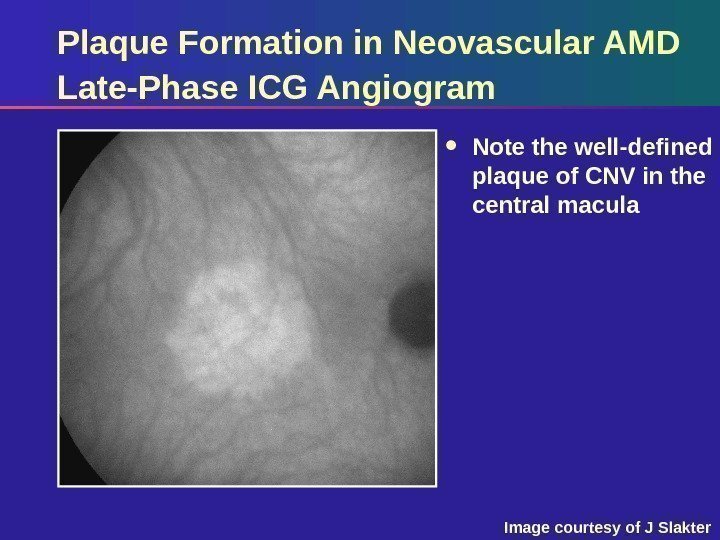 Plaque Formation in Neovascular AMD Late-Phase ICG Angiogram Note the well-defined plaque of CNV