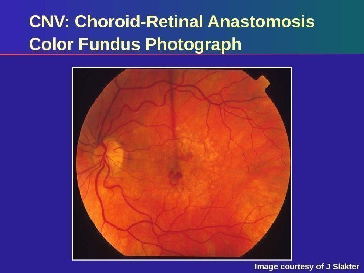 CNV: Choroid-Retinal Anastomosis Color Fundus Photograph Image courtesy of J Slakter 