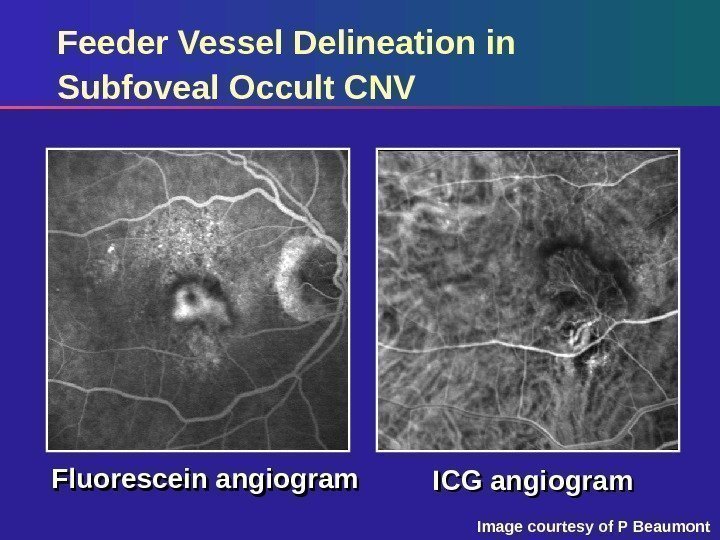 Feeder Vessel Delineation in Subfoveal Occult CNV Fluorescein angiogram ICG angiogram Image courtesy of