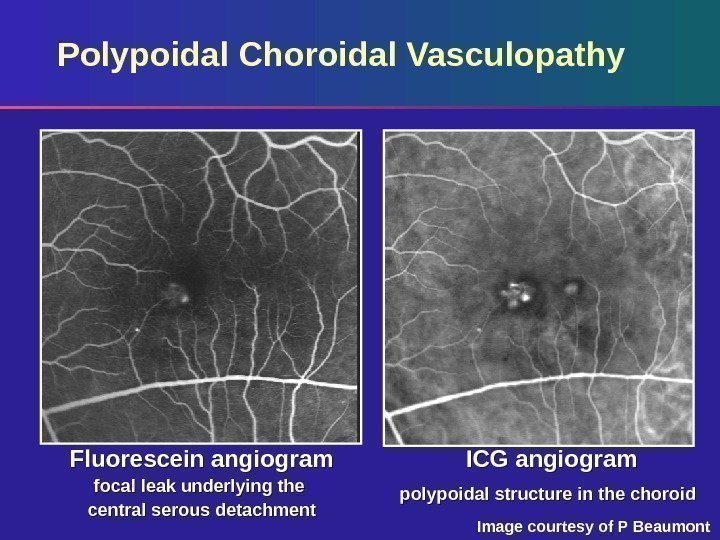 Polypoidal Choroidal Vasculopathy Fluorescein angiogram focal leak underlying the central serous detachment ICG angiogram