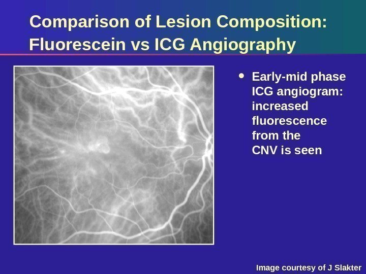 Comparison of Lesion Composition:  Fluorescein vs ICG Angiography Early-mid phase ICG angiogram: 